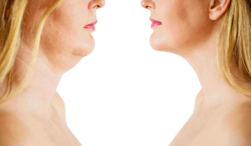 Double Chin treatment Wiltshire before and after results