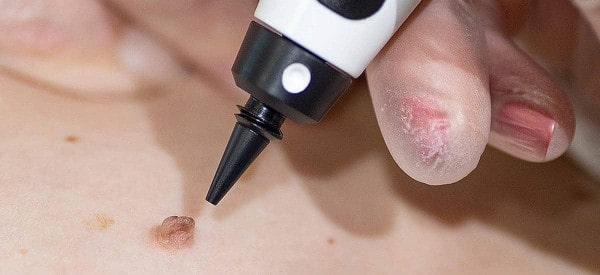 After Skin Tag Removal Wiltshire