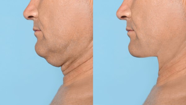 Which Non-Surgical Treatments Work Best for Jowls and Loose Skin Wiltshire?