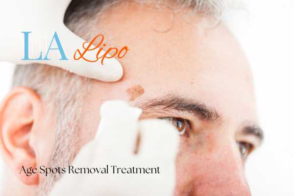 What Are the Most Effective Treatments for Age Spots Wiltshire?