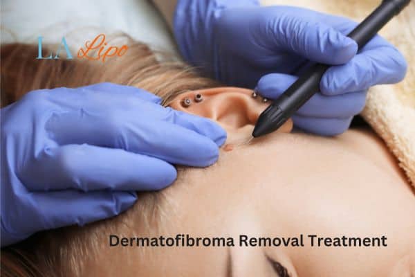 Dermatofibroma Removal Treatment Wiltshire