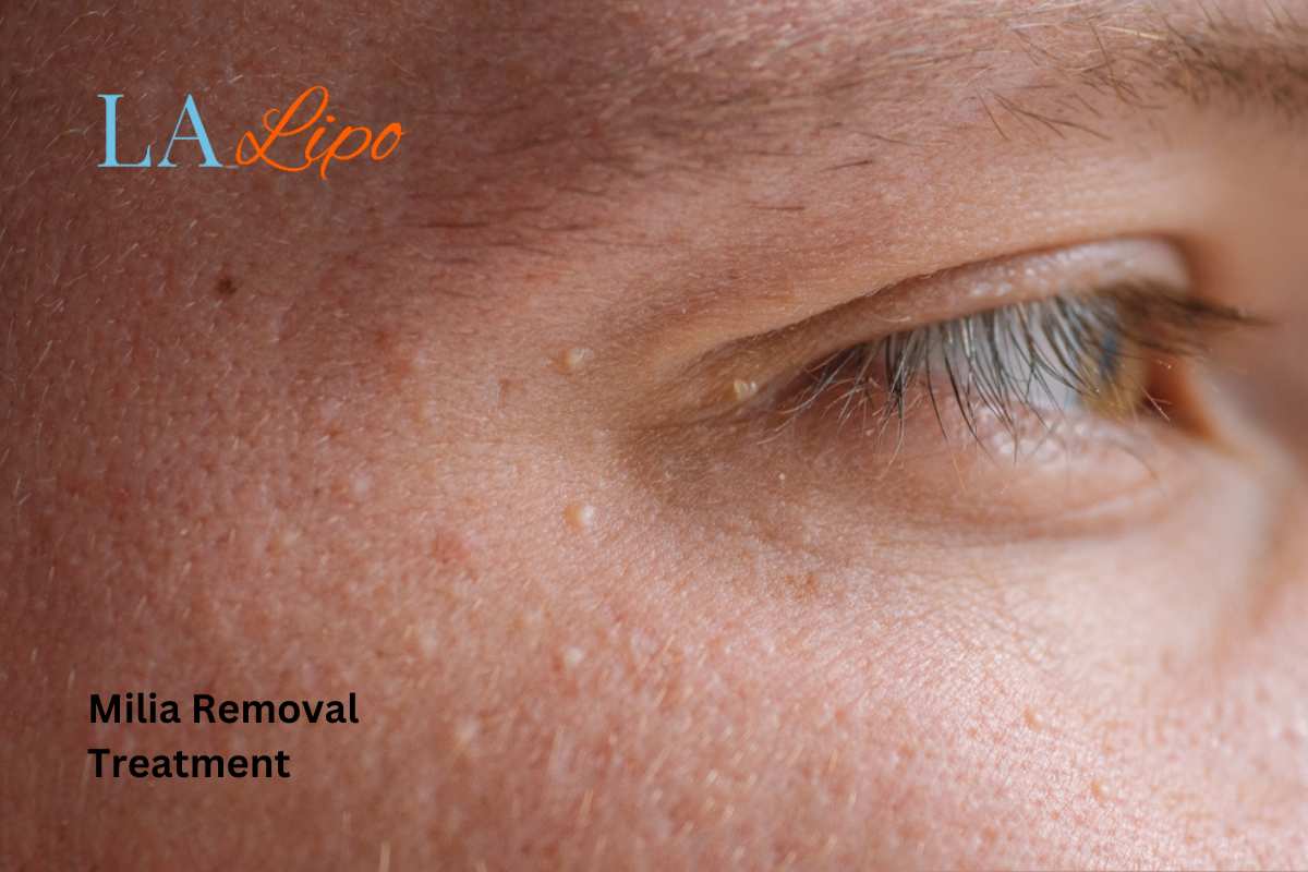 Cryopen Milia Removal: Is It the Easiest and Safest Option Wiltshire?
