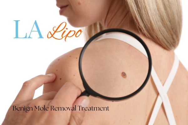 Why getting moles removed Wiltshire can boost your confidence!