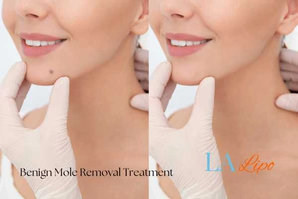 Woman's before and after results of being moles removal treatment Wiltshire