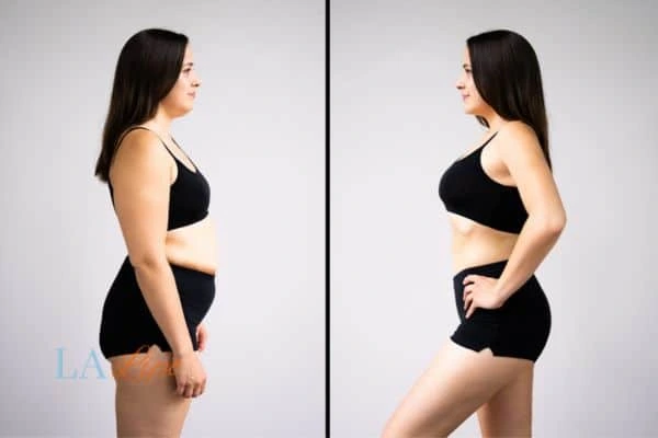 image of woman before and after results of LA-EMS Body Sculpting Wiltshire to help treat Diastasis recti
