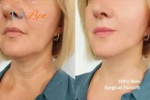 hi-fu for wrinkles Wiltshire before and after results