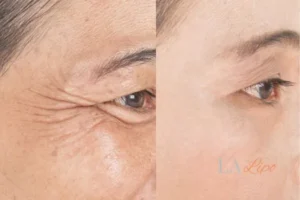 Before and after results of woman - HI-fu wrinkles reduction treatment Wiltshire