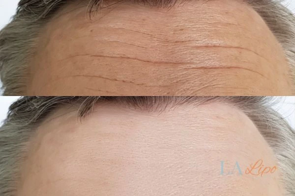 results of HIFU Wiltshire on mans forehead to help reduce lines and wrinkles