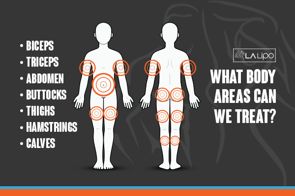 Graphic to show areas you can have LA-EMS Body Sculpting Wiltshire treatment.