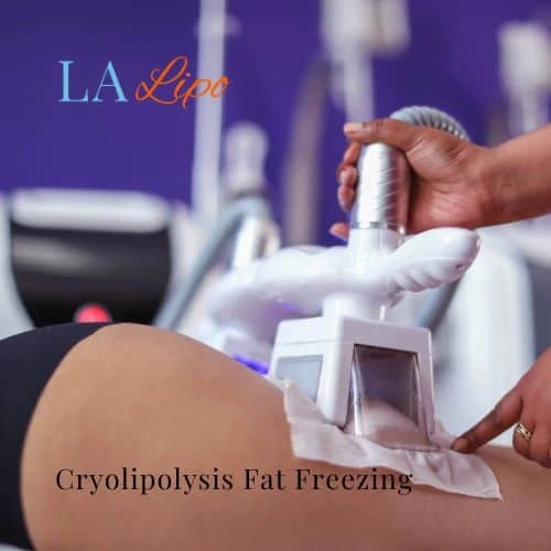 fat freezing - Cryolipolysis Wiltshire