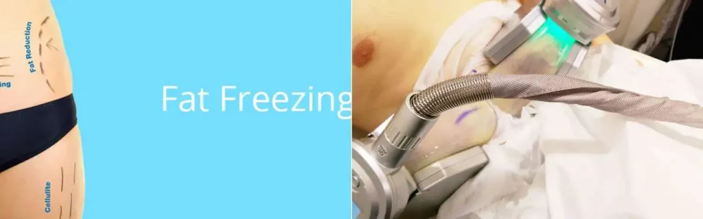 multi areas of a persons body having coolsculpting Wiltshire treatment