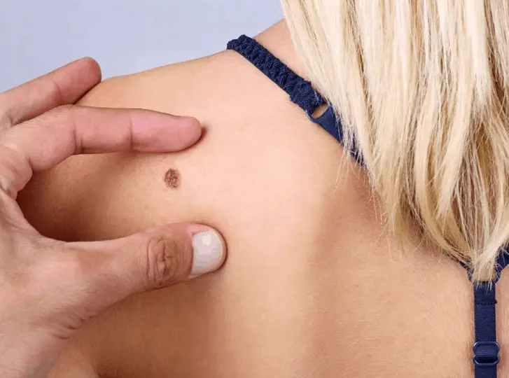 woman having mole removal Wiltshire consultation before treatment.