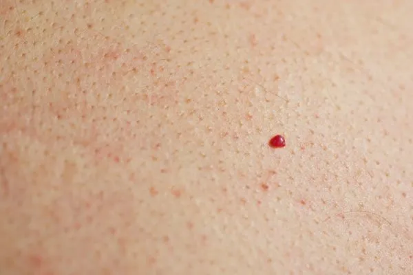 close up of a cherry angioma Wiltshire