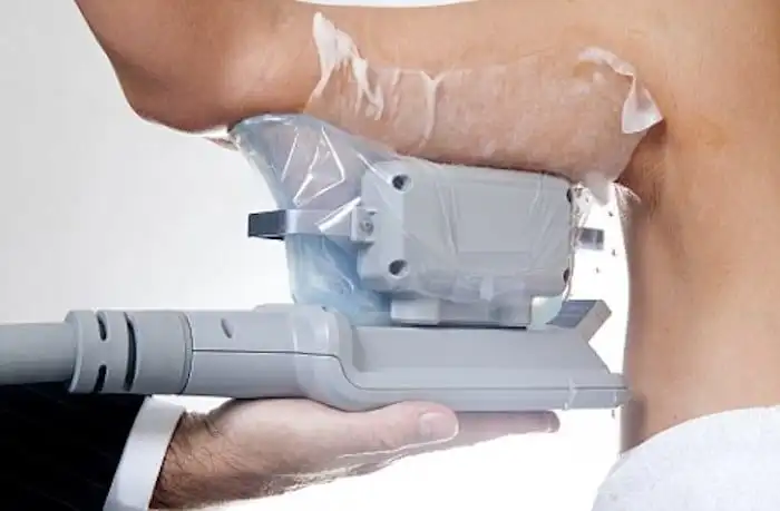 Picture of fat freezing Wiltshire on the upper arms.