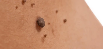 image of a skin tag Wiltshire