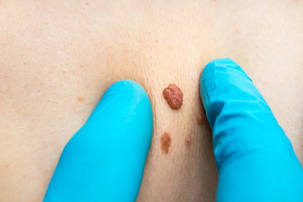 Consultant examining a skin tag Wiltshire