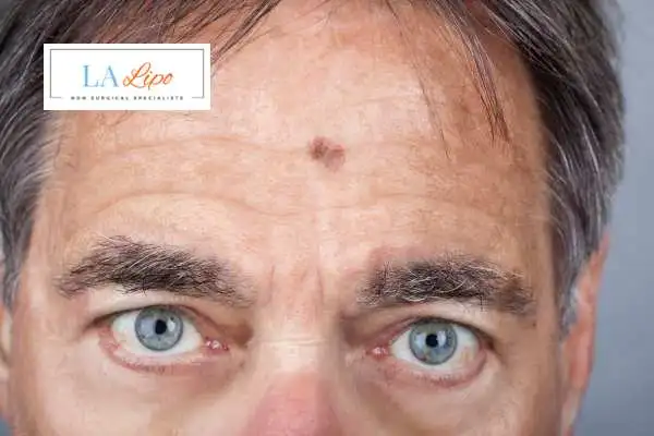 Solar Lentigo Removal Wiltshire image of man with mark on his forehead