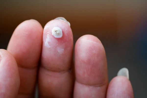 wart on person finger - cryotherapy to treat from LA LIPO Wiltshire