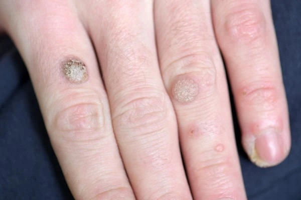 photo of warts on person hand - see wart removal Wiltshire from LA LIPO