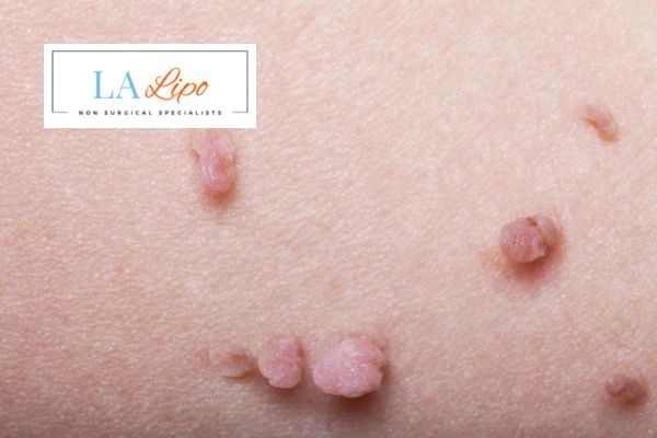 Does cryopen skin tag removal Wiltshire hurt? Find out now call our team today!