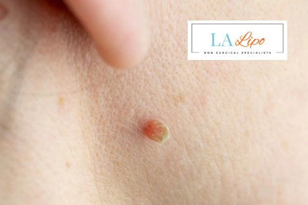 Book skin tag removal Wiltshire today speak to our team now!