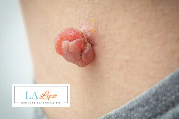 Interested in skin tag removal Wiltshire? Concerned about the pain? Find out more today!