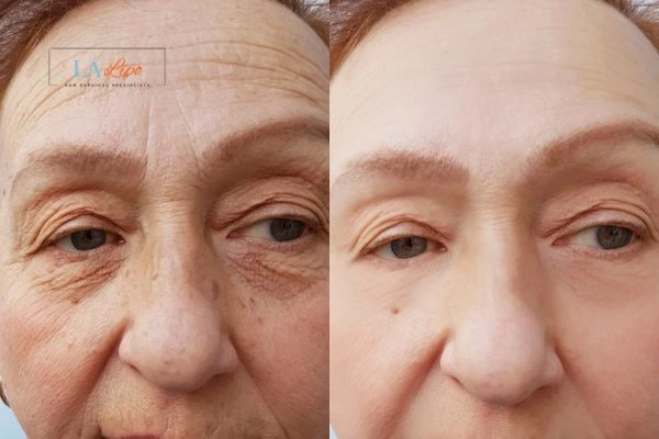 The powerful benefits of Morpheus8 Treatment Wiltshire - Call Our team today!
