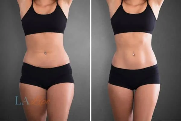 before and after results of non-surgical treatment to help a woman's body image and mental health Wiltshire