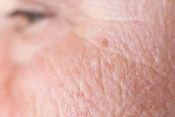 close up picture of a woman's face showing an age spot Wiltshire