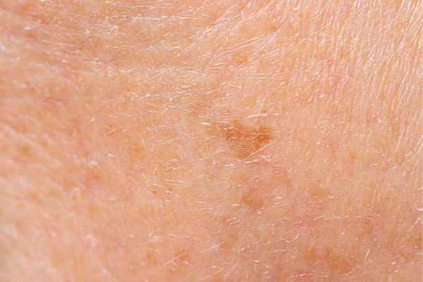 close up picture of age spots Wiltshire