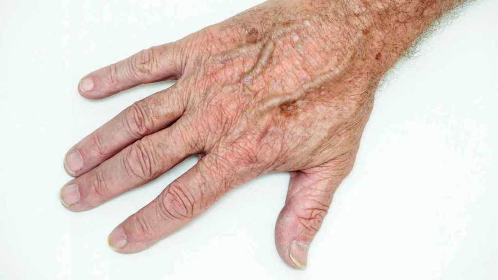 Male hand showing age spot Wiltshire