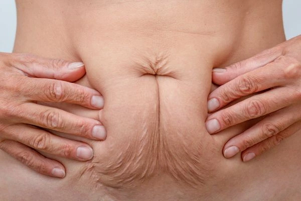 Image of a woman's stomach with loose skin - example of skin tightening Wiltshire options