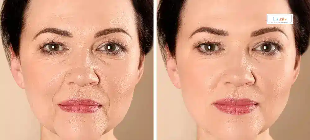 How Long Does It Take to See Results and How Long Do They Last Wiltshire?