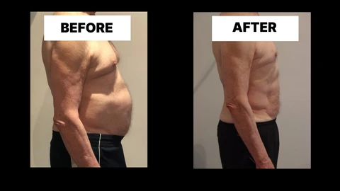 What Symptoms Can Diastasis Recti Cause in Men? Weak Core, Back Pain and Poor Posture Wiltshire